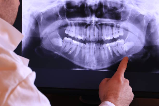 Best Emergency Tooth Extraction in Wlowbrook, IL